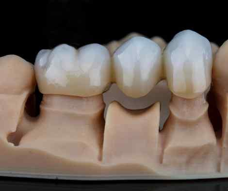 A dental model displaying a bridge supported by two crowns.