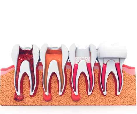 A dentist holding a dental model showing how a crown sits on a tooth after root canal treatment.