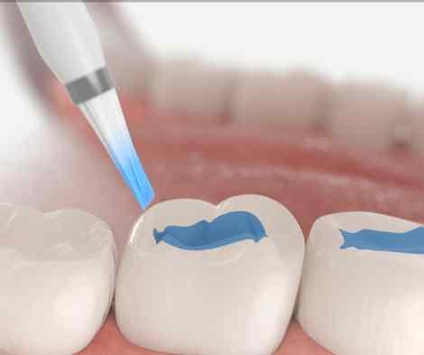 Image showing the liquid sealant being painted onto the tooth