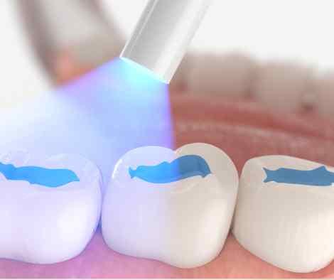 Image showing a curing light being used on the sealant