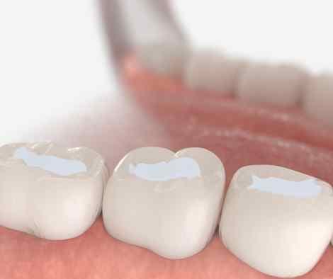 Image showing a dentist checking the hardened sealant