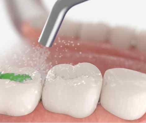 Image showing a tooth being dried after rinsing