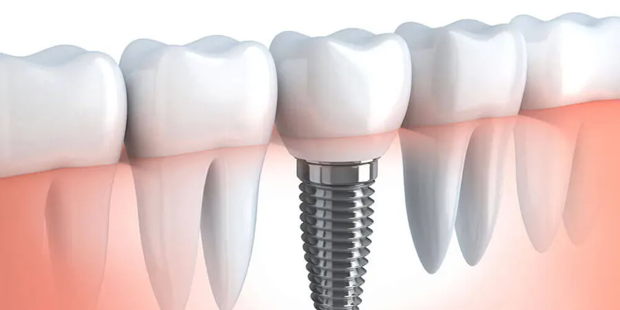 Dental Implants Mississauga
