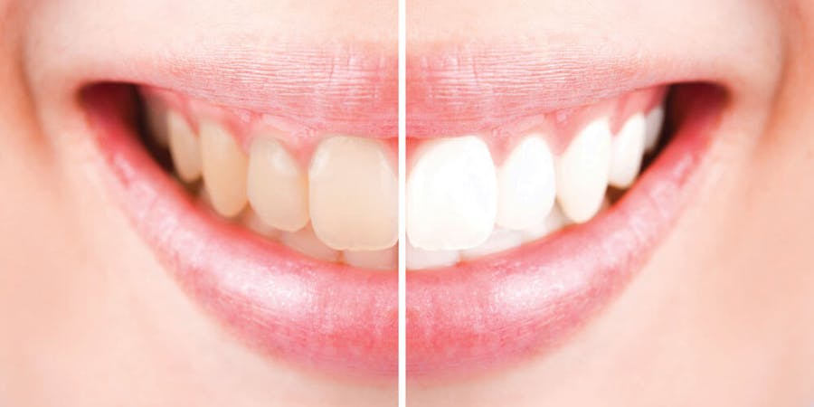 Teeth Whitening Mississauga