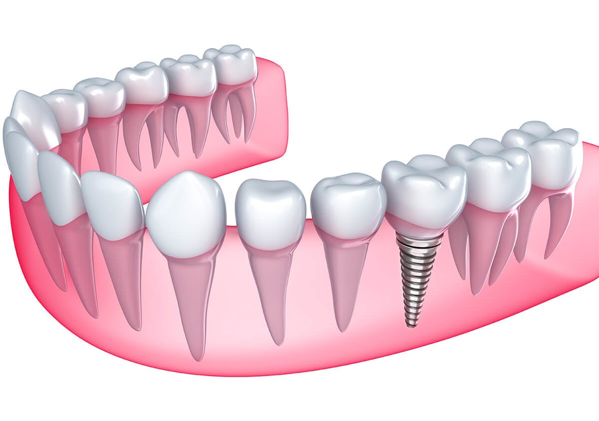 All you need to know about Dental Implants